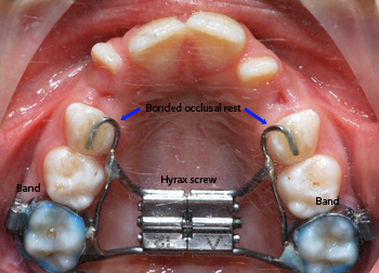 Banded Hyrax rapid palatal expander-Dr Chamberland orthodontist in Quebec City