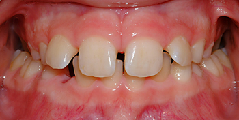 Bilateral posterior crossbite-Dr Chamberland orthodontist in Quebec City