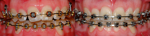 Attract versus SPEED en 2003-Dr Chamberland orthodontiste à Québec