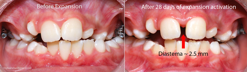 Before and after expansion-Dr Chamberland orthodontist in Quebec City