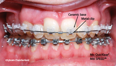 QuicKlear bracket JaMe-Dr Chamberland orthodontist in Quebec City