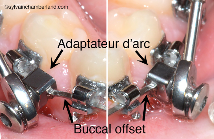 Buccal offset fil inférieur SUS2-Dr Chamberland orthodontiste à Québec