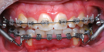 Clarity SL and SmartClip-Dr Chamberland orthodontist in Quebec City