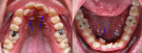 Class III upper and lower occlusal views