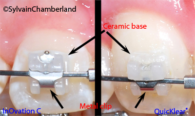 Comparison QuicKlear In-Ovation C-Dr Chamberland orthodontist in Quebec City