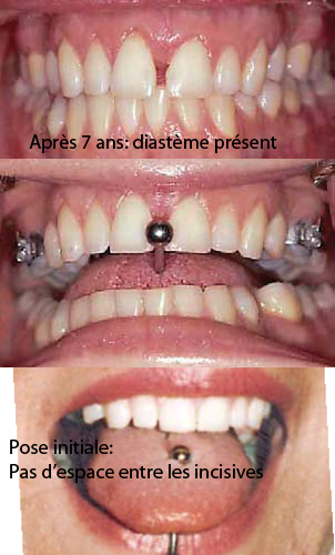 Piercing de la langue - Dr Sylvain Chamberland, Orthodontiste