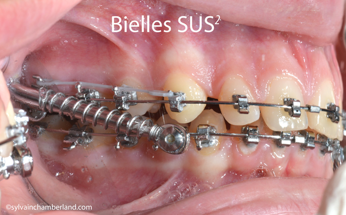 Bielles SUS2-Dr Chamberland orthodontiste à Québec