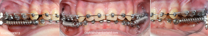 SUS2 corrector-Dr Chamberland orthodontist in Quebec City