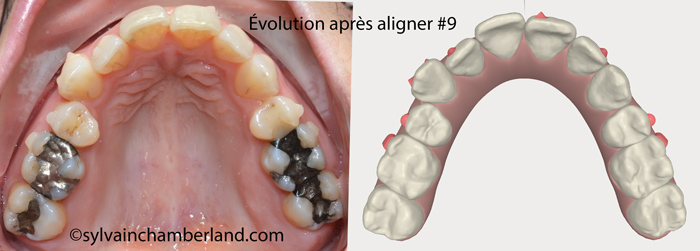 Evolution after aligner #9. Upper occlusal view.