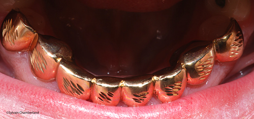 Grillz occlusal view JoDr-Dr Chamberland orthodontist in Quebec City
