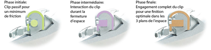 HARMONY phase initiale intermédiaire et finale-Dr Chamberland orthodontiste à Québec