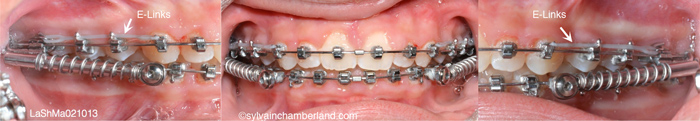 SUS2 correctors-Dr Chamberland orthodontist in Quebec City