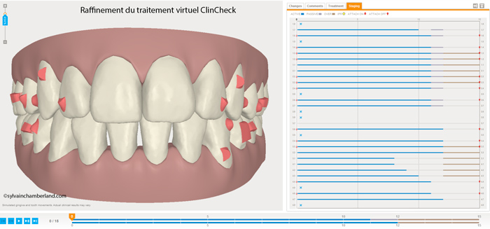 Nouvelle séquence de traitement virtuel recommandé par le raffinement du ClinCheck