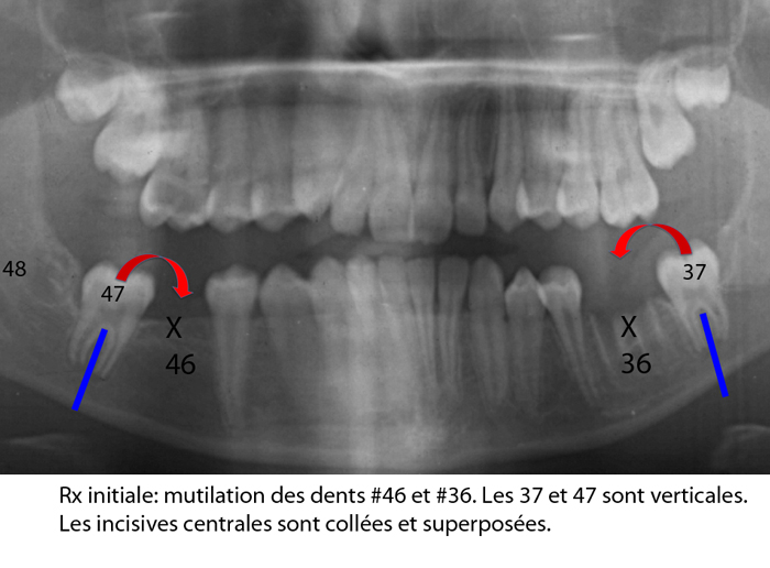 Mutilation-dentaire_affaissement-de-locclusion_collapse-de-la-dimension-verticale_orthodontiste-Chamberland-Quebec-1