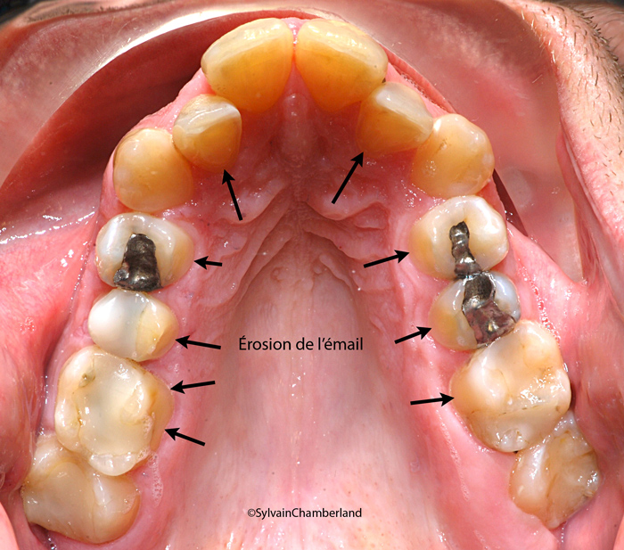 PaBe érosion dentaire boisson gazeuse 19-06-2012-Dr Chamberland orthodontiste à Québec