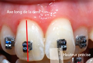 Position précise des brackets-Dr Chamberland orthodontiste à Québec