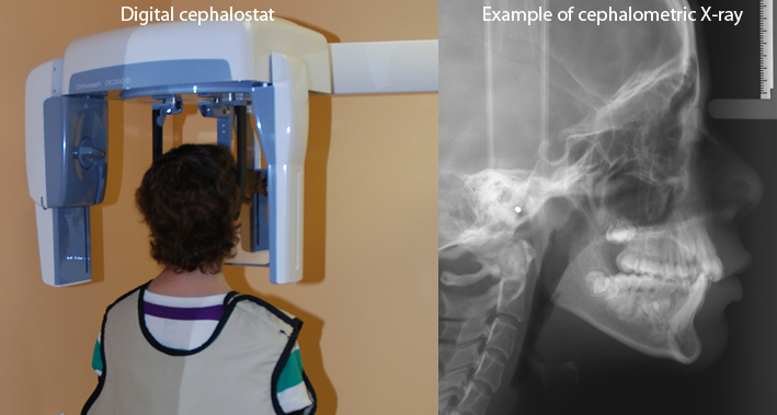 Taking cephalometric X-rays-Dr Chamberland orthodontist in Quebec City