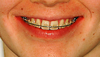 Sourire bracket blanc-Dr Chamberland orthodontiste à Québec