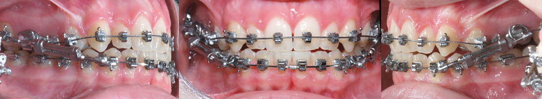 Twin Force Bite Corrector-Dr Chamberland orthodontist in Quebec City
