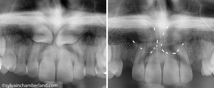 Bilateral-impacted-canine-and-radicular-resorption-JaSa-Chamberland-orthodontist-Quebec